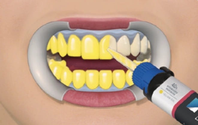 Zestaw do profesjonalnego wybielania zębów - Whitesmile Power Whitening - Stomatologia - zdjęcie 3