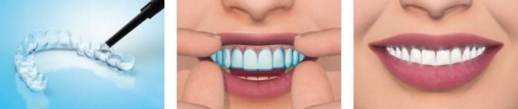 Zestaw do domowego wybielania zębów Whitesmile Home Whitening - Stomatologia - zdjęcie 4