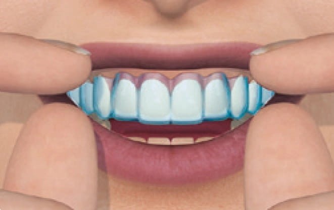 Zestaw do domowego wybielania zębów Whitesmile Home Whitening - Stomatologia - zdjęcie 5